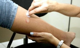 Dados alarmantes: hanseníase dispara em MT e Estado e Municípios são pressionados a agir